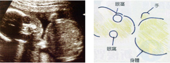 图解怀孕中期b超(13-24周)