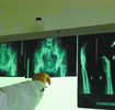 核磁共振成像可以更准确的诊断骨折情况